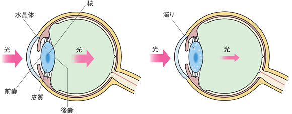 正常な眼球と白内障の眼球