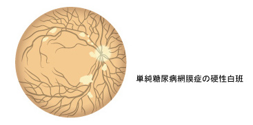 単純糖尿病網膜症の硬性白班