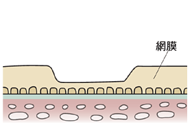 加齢黄斑変性の見え方