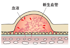 加齢黄斑変性の見え方